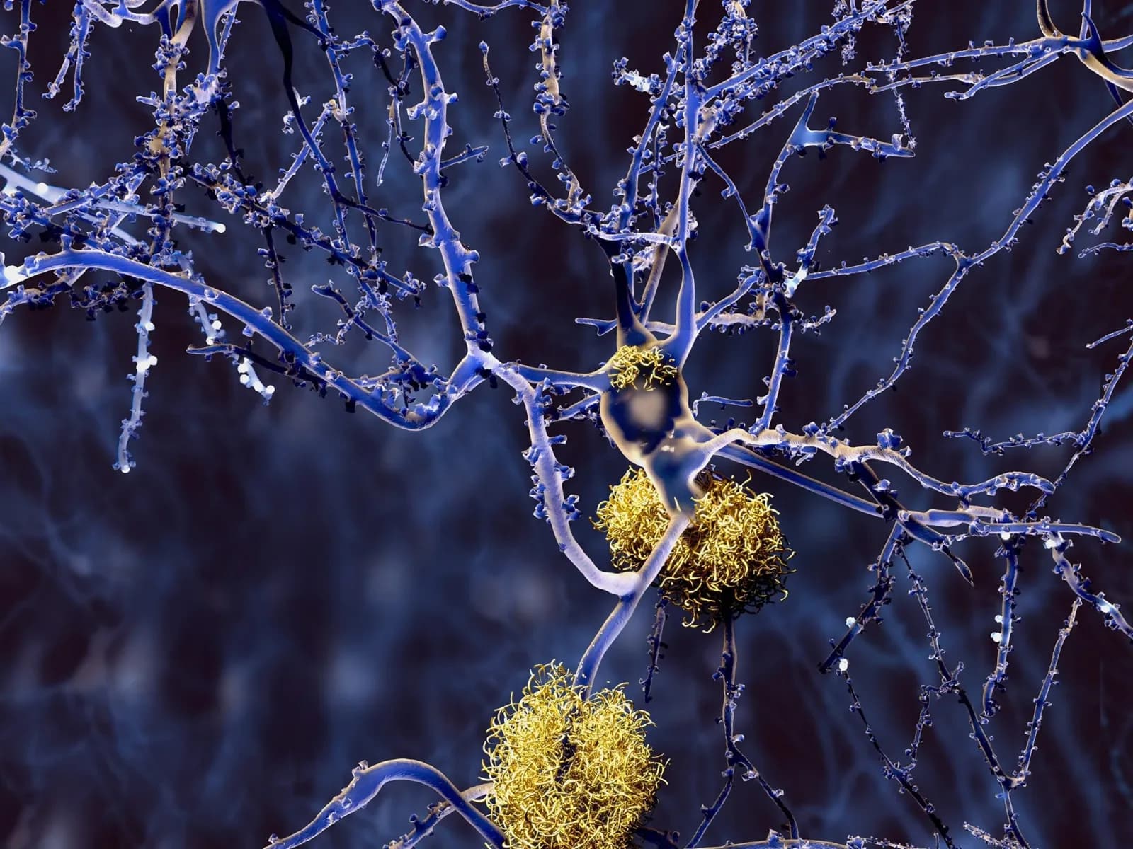Wissenschaftler identifizieren einfaches Nahrungsergänzungsmittel, das Alzheimer-Schäden deutlich mindert
