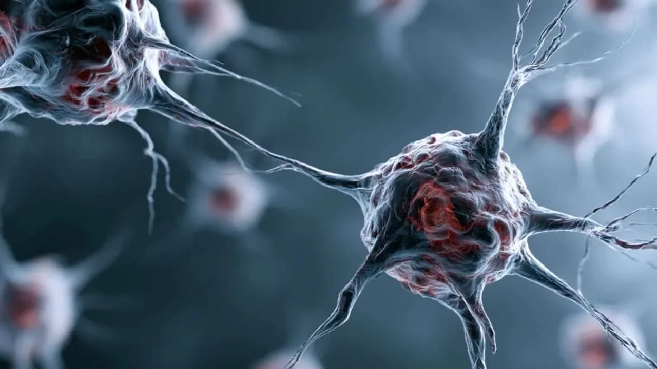 Vireninfektionen als Auslöser für Parkinson-Krankheit bestätigt