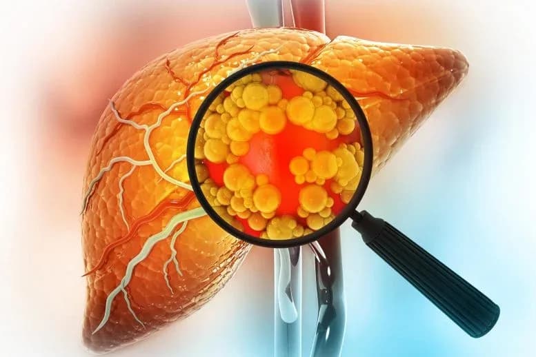 Allgemeines Asthmapräparat könnte gefährliche Fettlebererkrankung umkehren