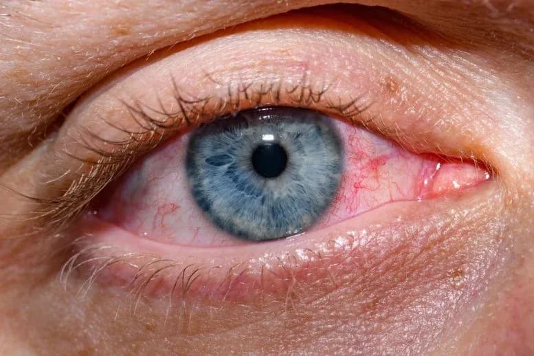 Wissenschaftler entwickeln experimentelles Augentropfen-Präparat, das trockenes Auge revolutionieren könnte