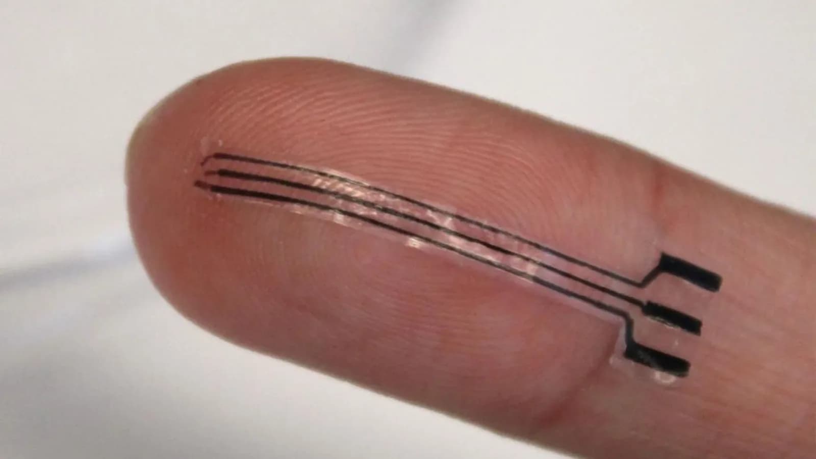 3D-gedrucktes dehnbares Arterienimplantat senkt Blutdruck um 15 %