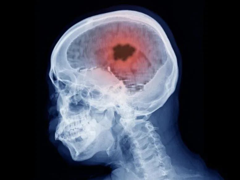 Neue Vitamin-B12-Therapie könnte die Behandlung von Hirntumoren revolutionieren