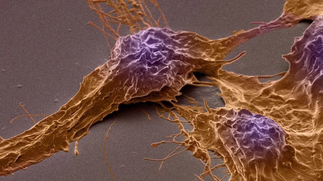 Tödlicher Hirntumor wächst durch Aktivität im Gehirn