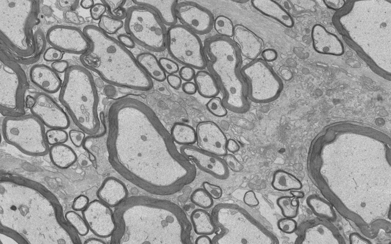 Wissenschaftler könnten einen Weg zur Reparatur von Nervenschäden bei Multipler Sklerose gefunden haben