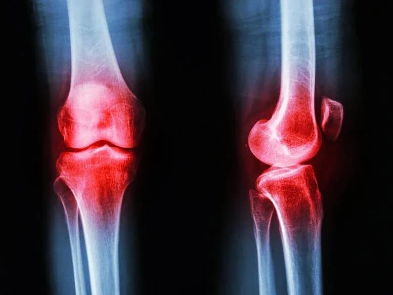 Wissenschaftler entdecken Protein, das Osteoarthritis stoppen könnte