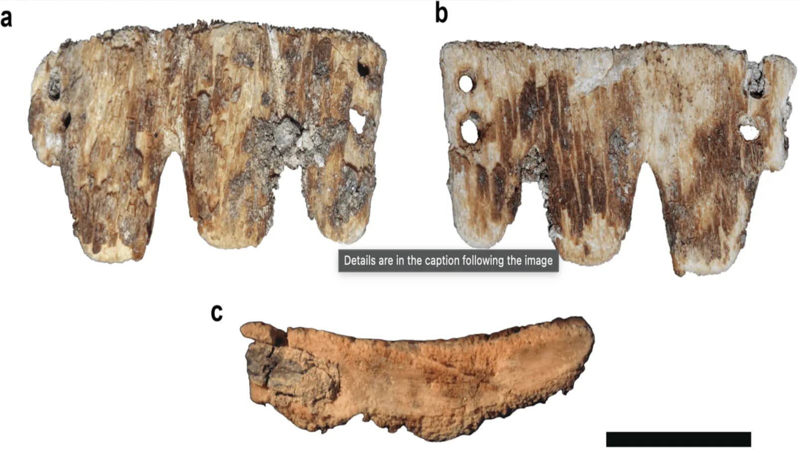 Seltene Zahnprothese aus dem 19. Jahrhundert entdeckt in portugiesischem Schädel
