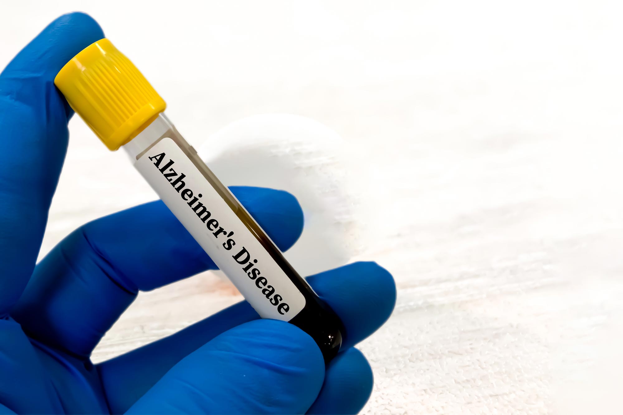 Ihr Bluttest könnte bereits ein Risiko für Alzheimer aufzeigen