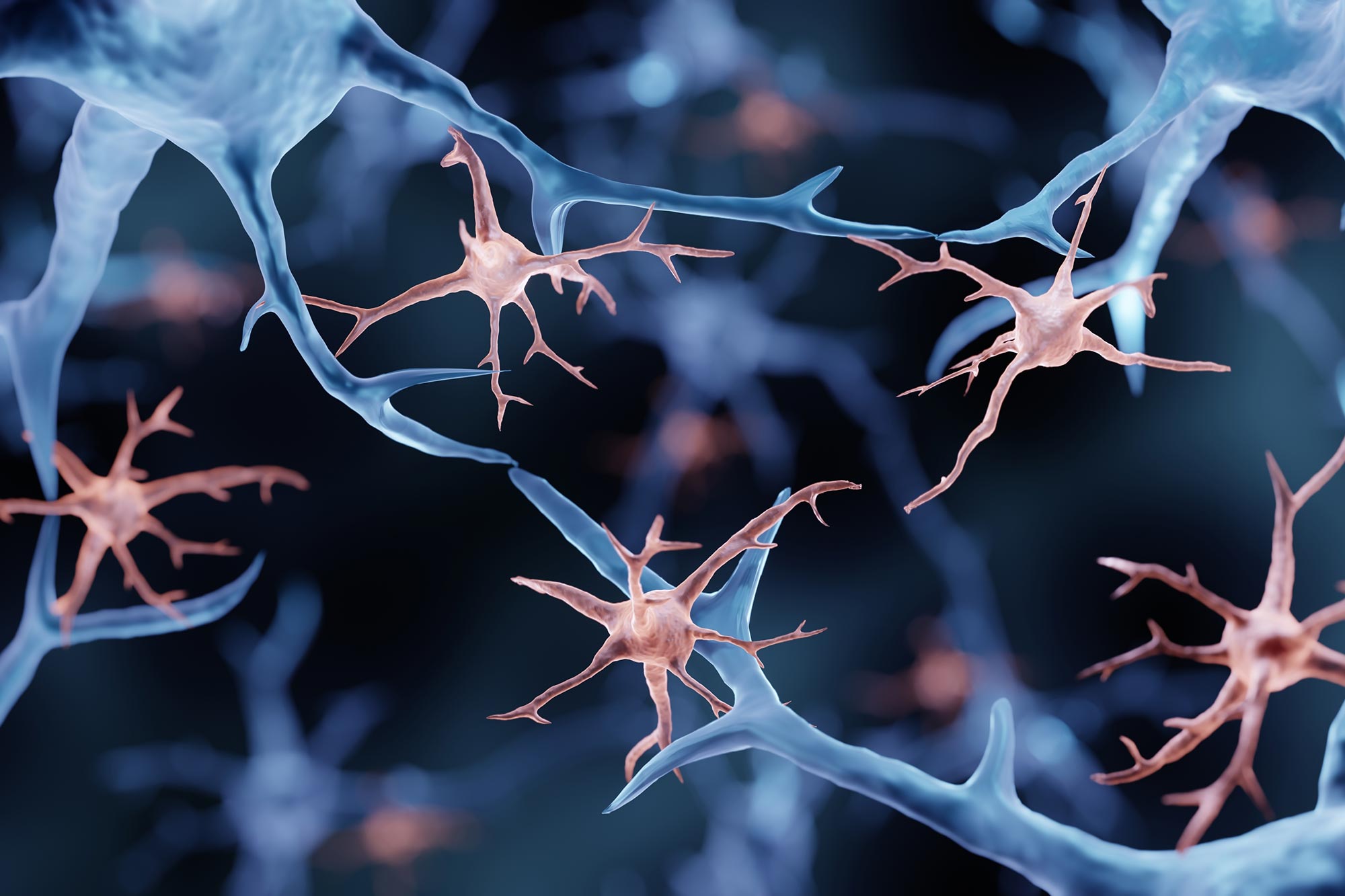 Krebsähnliche Mutationen im Gehirn könnten die Ursache für Alzheimer-Krankheit sein