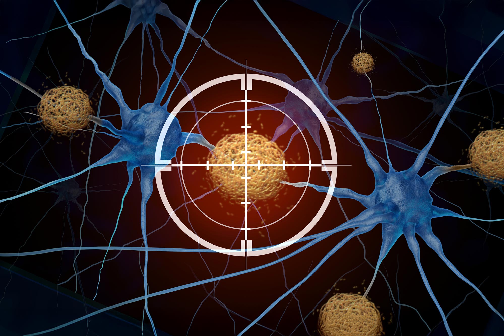 Große Übersichtsarbeit zeigt: Alzheimer-Amyloid-Medikamente bringen keinen wirklichen Nutzen