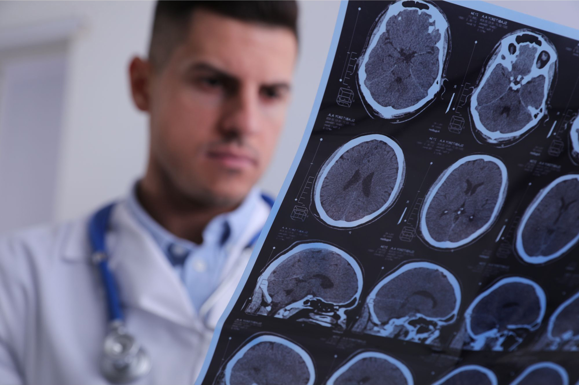 Wissenschaftler könnten einen Weg zur Reparatur von Nervenschäden bei Multipler Sklerose gefunden haben