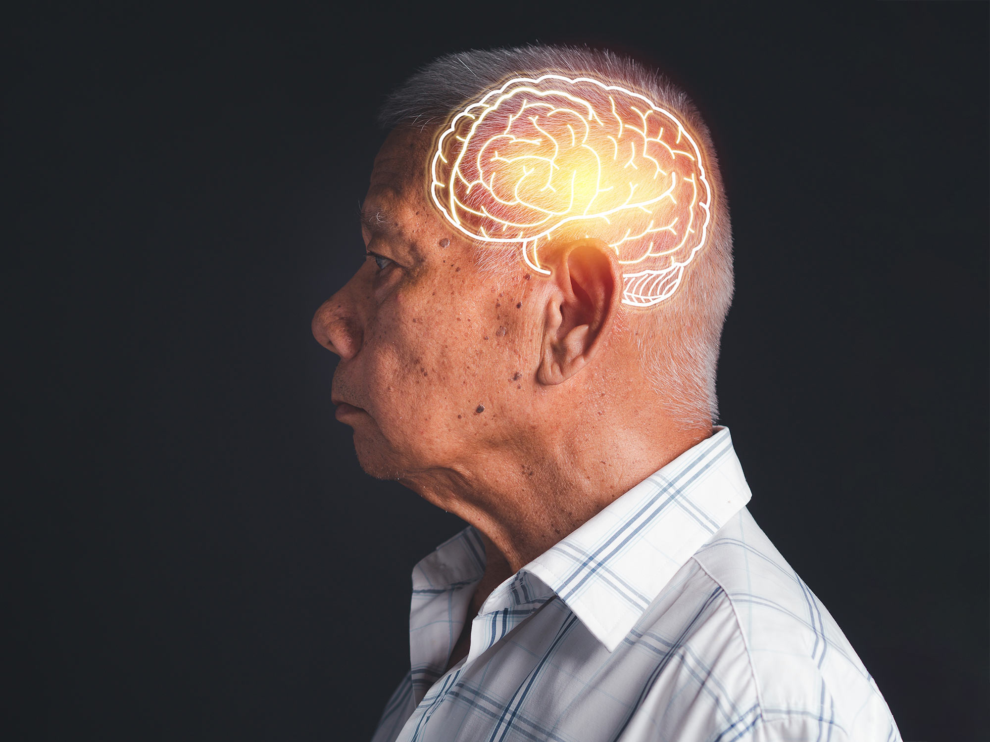Alzheimer könnte Jahrzehnte früher beginnen als angenommen, so eine neue Studie der Mayo Clinic