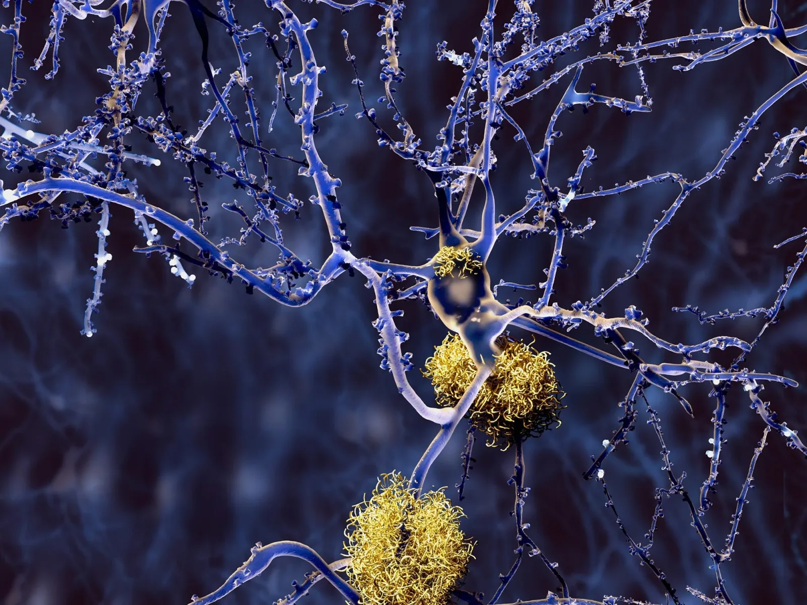 Wissenschaftler identifizieren einfaches Nahrungsergänzungsmittel, das Alzheimer-Schäden deutlich mindert