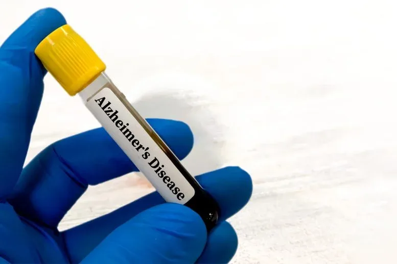 Ihr Bluttest könnte bereits ein Risiko für Alzheimer aufzeigen