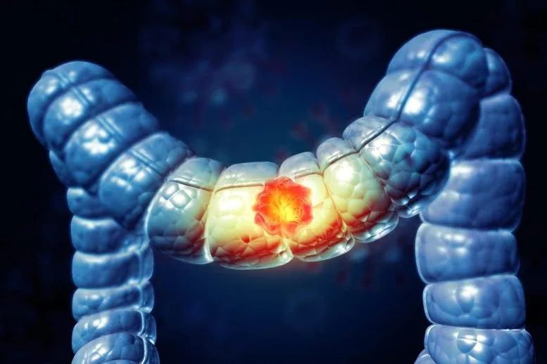Researchers Solve 15-Year Mystery Behind Cancer-Causing Gut Toxin