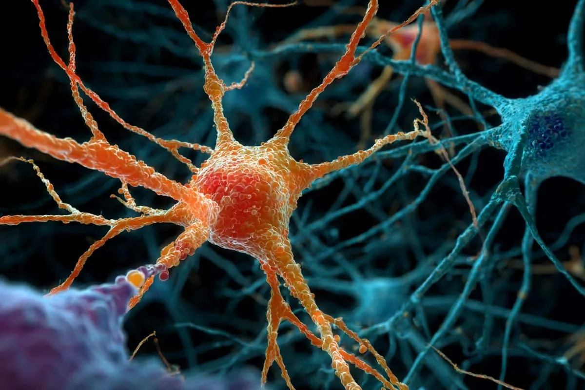 Microglia Overloaded with Fat Linked to Rapid MS